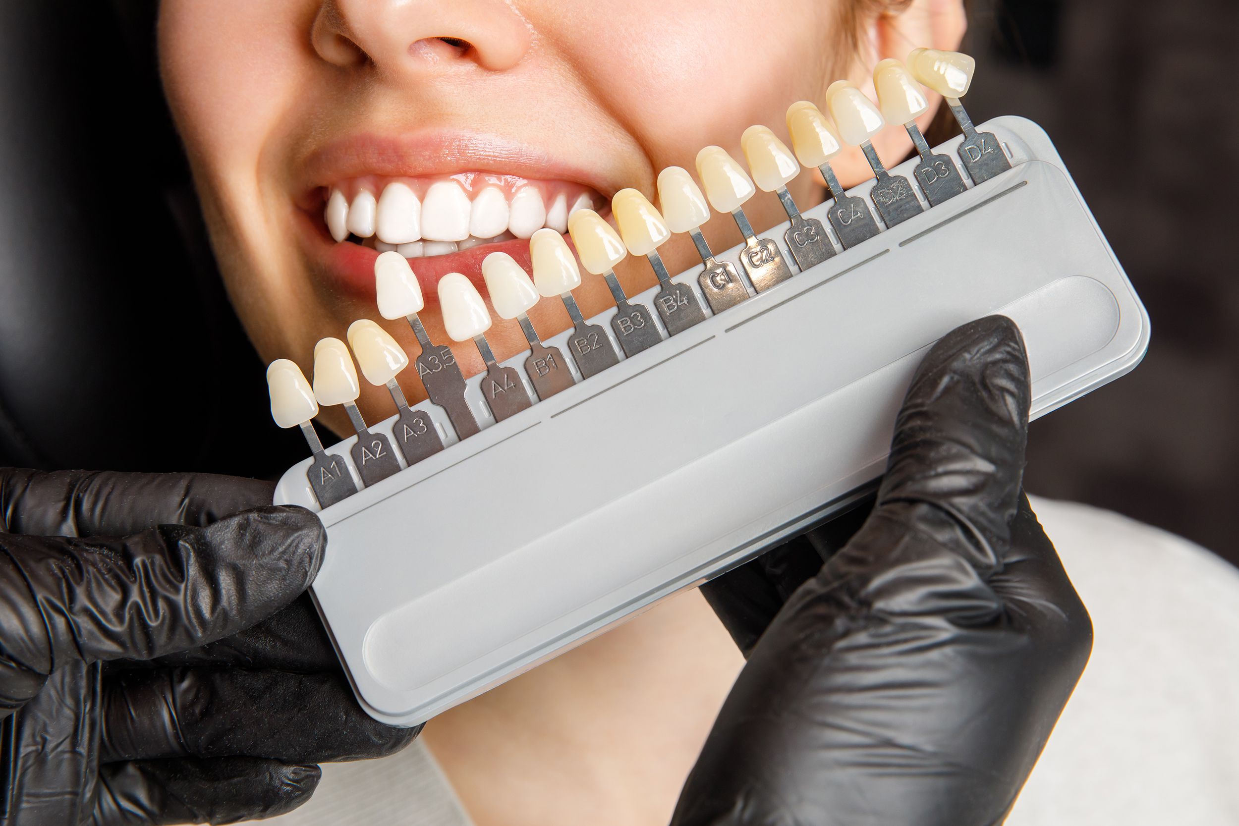 Lamine Diş Kaplama - Emax