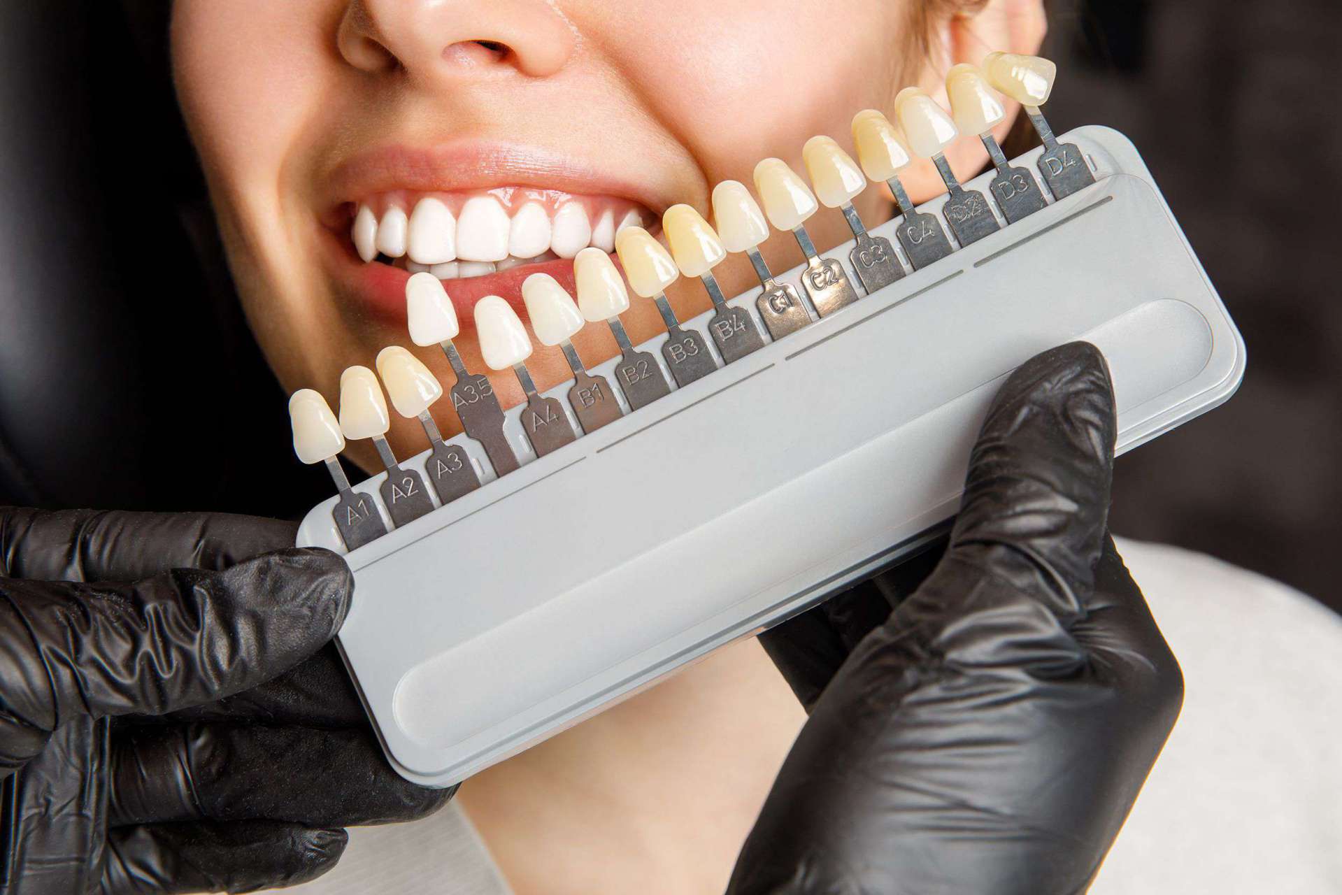 Porcelain Veneers – Emax